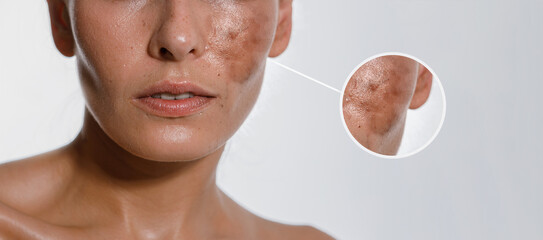 Hyperpigmentation of female skin, close-up of a part of the face on a white background,...