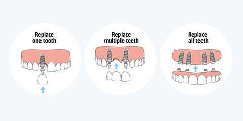 Types of dental implants to replace one tooth, multiple teeth and all teeth