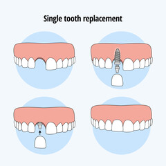 Single  tooth replacement. Dental Implant