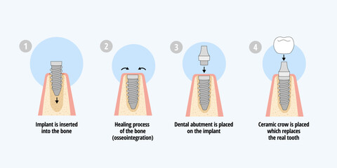 Single dental implant placement process