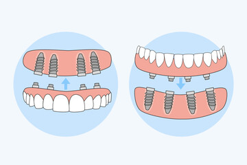 All on 4 dental implants Immediate Loading Functional Implants