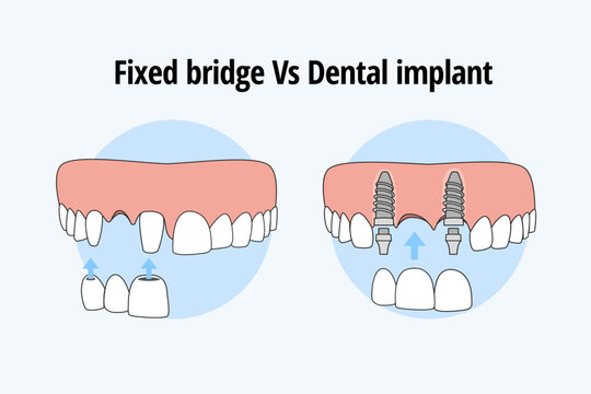 Thooth replacement whit a traditional bridge Vs dental implant