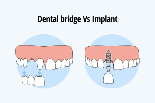 Thooth replacement whit a traditional bridge Vs dental implant