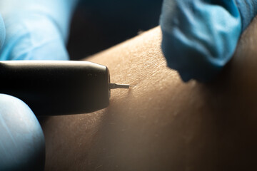 process of permanent unwanted hair removal, using an electroepilation device, close up macro photo