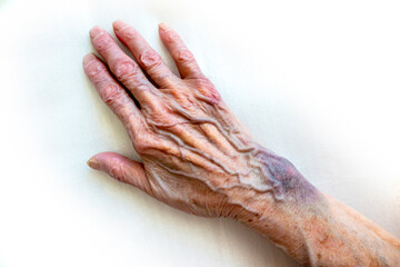 the hand of an elderly woman with bruises