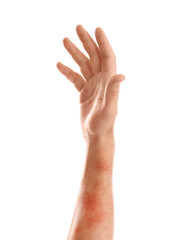 Fototapeta premium Man showing hand with dry skin on white background, closeup