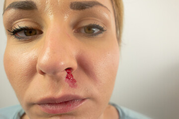 Young beautiful woman with bleeding nose. Domestic violence, tyranny, despotism, women rights, victim concept