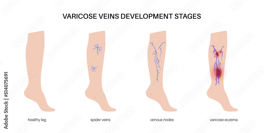 Poster Varicose veins treatment