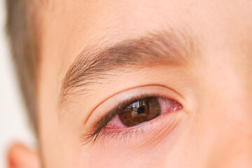 eye of a child reddened due to allergy
