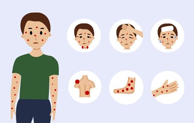 Monkeypox virus symptoms illustration with male character.
Monkeypox outbreak concept by world health organization with examples and explanation.