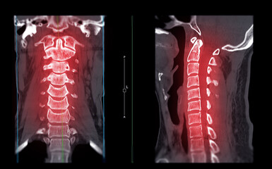CT SCAN of Cervical Spine ( C-spine ).