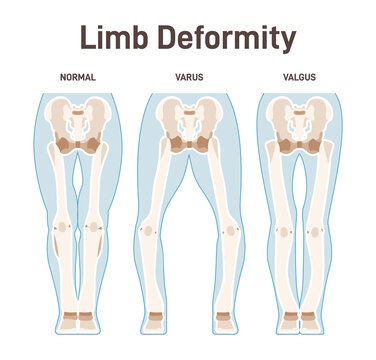 Limb anatomy scheme. Valgus and varus leg deformities. Diagram of normal