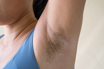 Woman showing her arms up and showing armpit hair.Unshaven armpit hair. Problem skin under the armpit. Healthcare and skincare concept.
 - obrazy, fototapety, plakaty