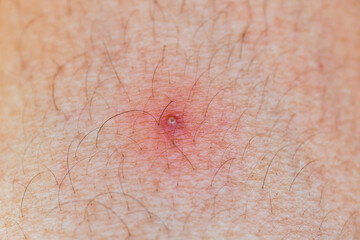 legs with red spot and scar from Mosquito bites