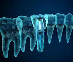 Illustration of teeth and dental implant on dark blue background