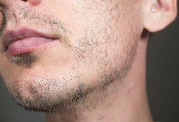Short, sparse beard on mans face. Hair growth problems. Man with alopecia area in the beard....