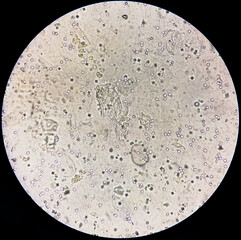 Microscopic image showing Calcium oxalate crystal and others urinary crystals from urine sediment.