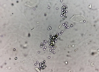 Microscopic image showing Calcium oxalate crystal from urine sediment.