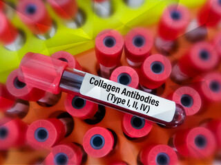Blood sample isolated for Lipid Profile, creatinine, ALT test with abnormal report.
