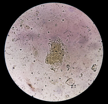 Microscopic Image Showing Calcium Oxalate Crystal And Others Urinary Crystals From Urine Sediment.