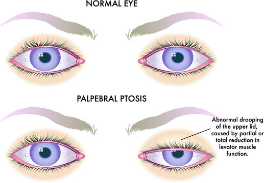 Medical illustration shows the comparison between a normal eye and one affected by palpebral ptosis.