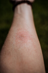 Red spot from a mosquito bite, swelling of the skin after a midge bite, irritation allergy to...
