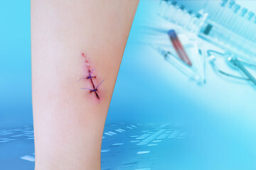fresh sutured wound on child's leg, wound care in hospital, non-absorbable sutures on the skin,...