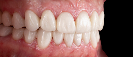porcelain crowns and veneers on teeth