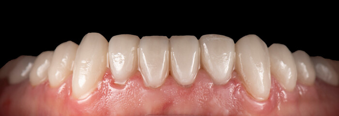 porcelain crowns and veneers on teeth