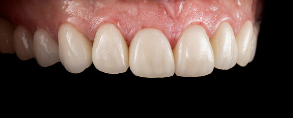 porcelain crowns and veneers on teeth