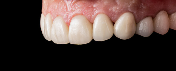 porcelain crowns and veneers on teeth