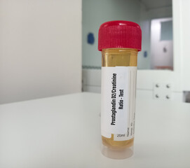 Urine sample for Prostaglandin D2Creatinine Ratio test, Aspirin-exacerbated respiratory disease, Urinalysis.