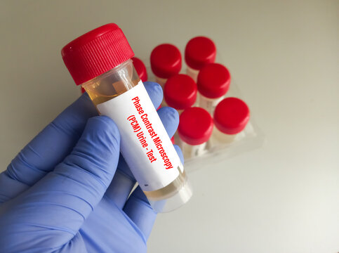 Urinalysis, Urine Sample For Phase Contrast Microscopy(PCM) Test, Close And Focus View.