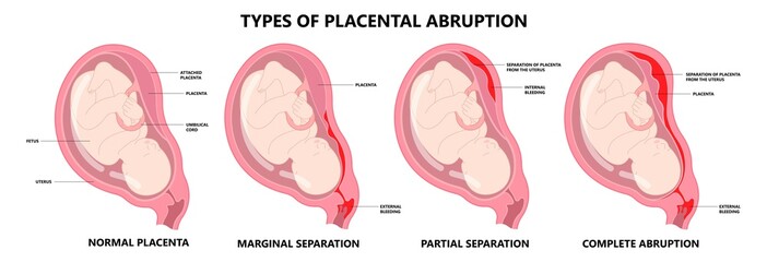 uterus cervix contraction and vasa previa fetal infant baby born c section nuchal cord twins fetus defect vessels funic labor growth low lying birth fluid of PROM test increta Bilobed sac neck knotted