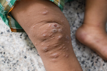Scabies Infestation with secondary or superimposed bacterial infection and pustules in leg of...
