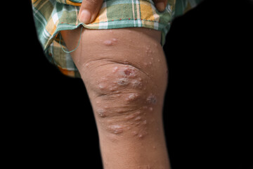 Scabies Infestation with secondary or superimposed bacterial infection and pustules in leg of...
