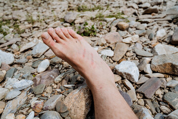 Redness of the skin burns the first degree, the leg lies on the stones, the person scratched the...