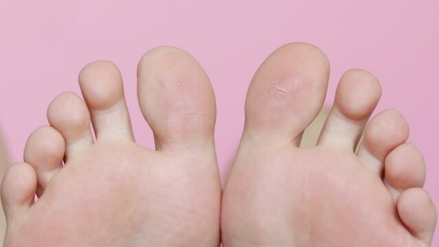 feet raised up on light pink background. dry skin of heels.irritated toe skin,cutted.cracked heels and peeled skin of soles.treatment beauty procedures health care.space for text