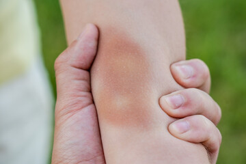 Man's hand keep woman's hand with bruise. Violence against women. Battering a woman and domestic violence