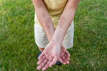 A wooman shows bruises on her arms (hands).