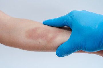 Doctor palpates and examines a large bruise on woman's arm isolated