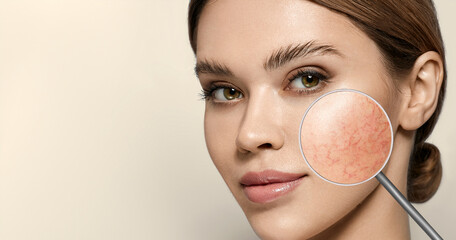 Magnifying glass showing couperose on face skin. Woman showing problems couperose-prone sensitive skin - obrazy, fototapety, plakaty