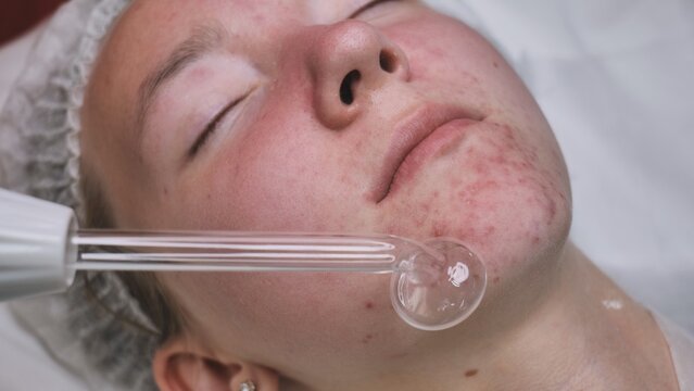 A beautician makes a darsonvalization of the face of a young girl with problem skin.