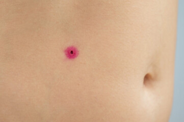 Close-up of a removed wart on a woman's abdomen. Human papillomavirus after burning.