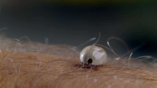 Tick infected with encephalitis or lyme disease is preparing to sting a person in the body. Dangerous blood-sucking parasite before biting on the surface of the body. Ticks (order Ixodida) arachnids
