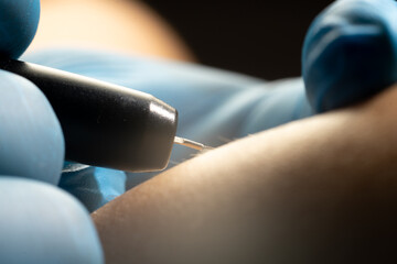 process of permanent unwanted hair removal, using an electroepilation device, close up macro photo