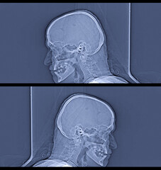 Human head on CT scan. Medical, science and education mri brain background. Magnetic resonance...