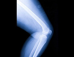 x-ray image of both knee, human's knee joints