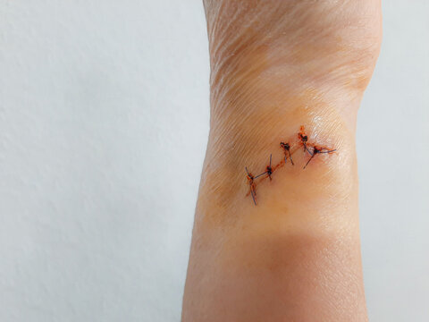 Wound and stitches on the arm of an elderly female patient, home accidents, elderly care at home