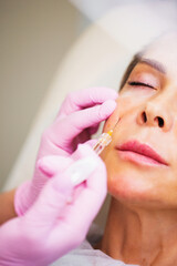 Close-up of a female doctor hand during a subcutaneous injection procedure with fillers to rejuvenate the patient's skin - aesthetic medicine